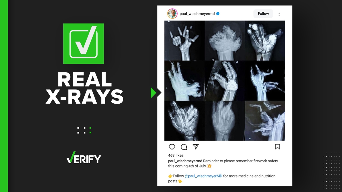 Hand X-ray photo shows what real firework hand injuries look like [Video]