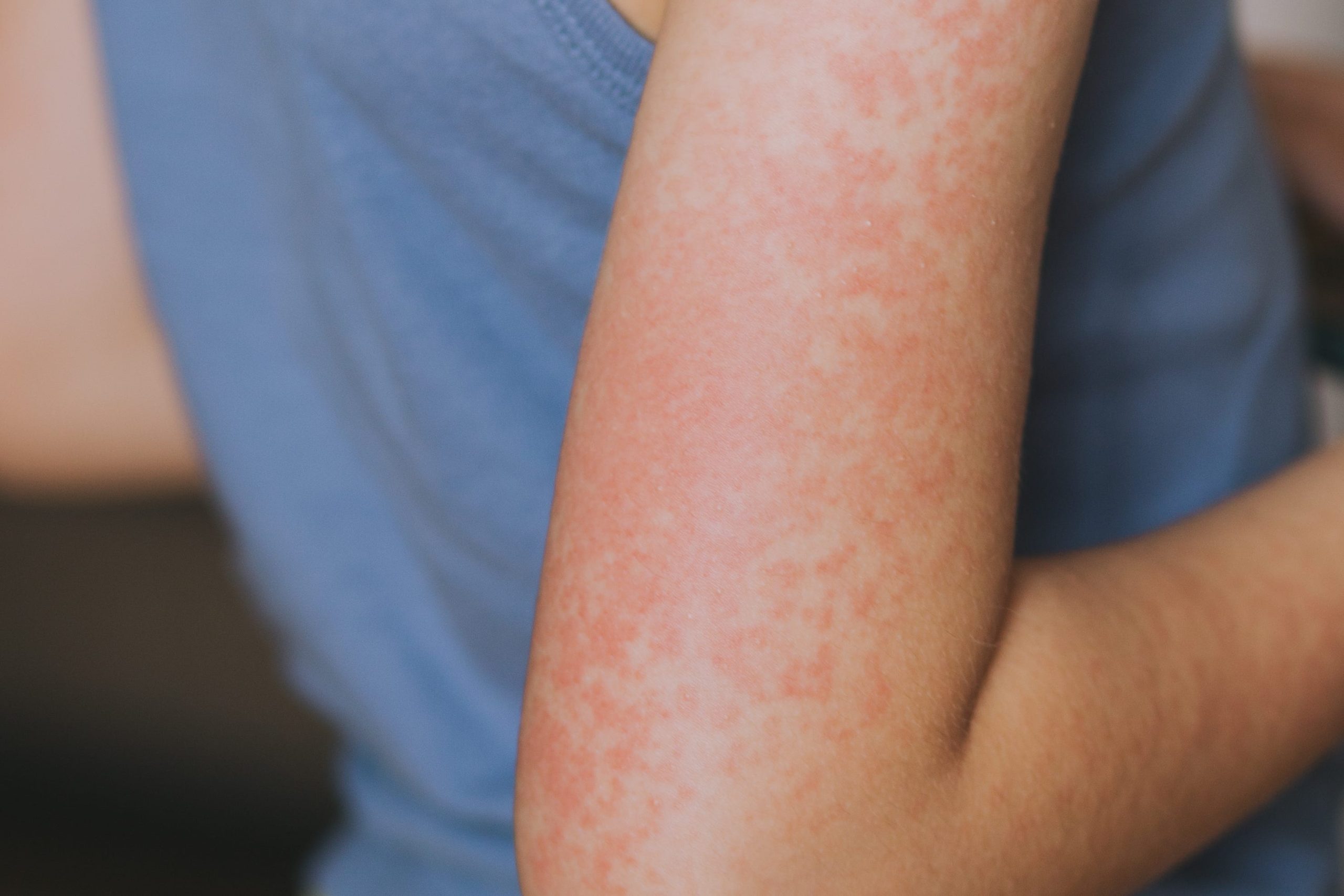 Second case of measles confirmed in Wayne County [Video]