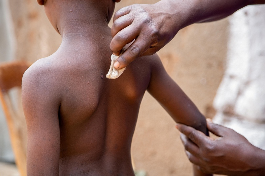 Childrens agency Unicef issues emergency tender to secure mpox vaccines [Video]