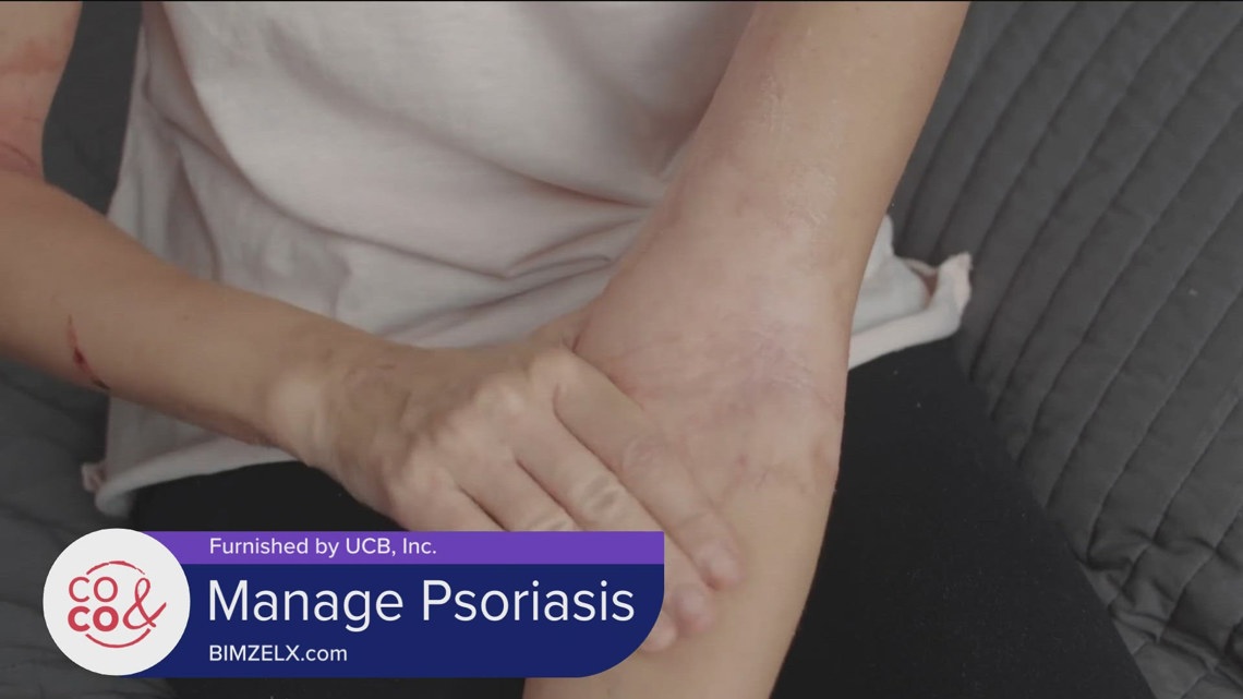 Treatment for Plaque Psoriasis | 9news.com [Video]