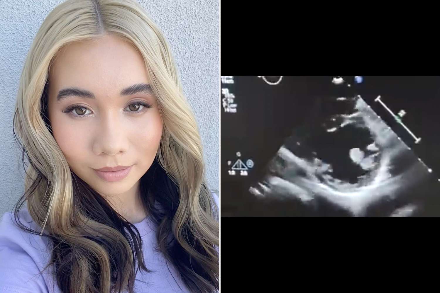 What Happened to Lil Tay? All About Her Medical Emergency [Video]