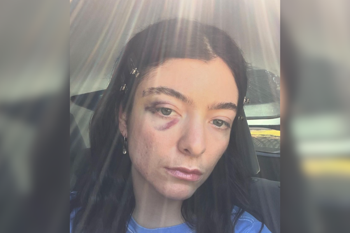 Lorde fans express concern after singer shares selfie with black eye [Video]