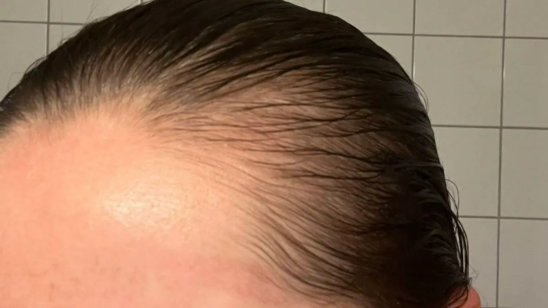 I was going bald at the front of my head & hair oiling did nothing – but a 10-second treatment got my hairline back [Video]