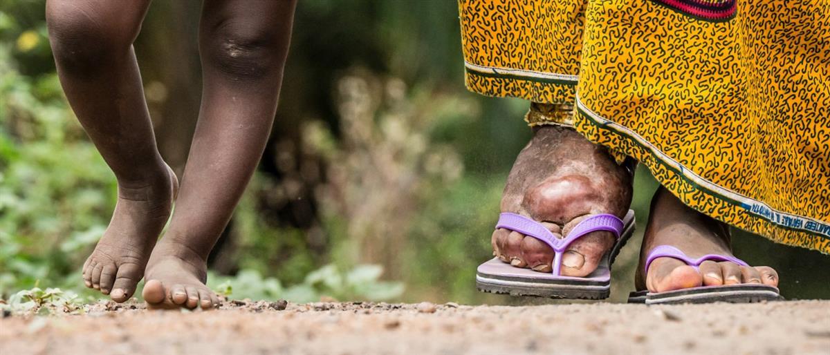 India’s Robust Strategy Against Lymphatic Filariasis [Video]