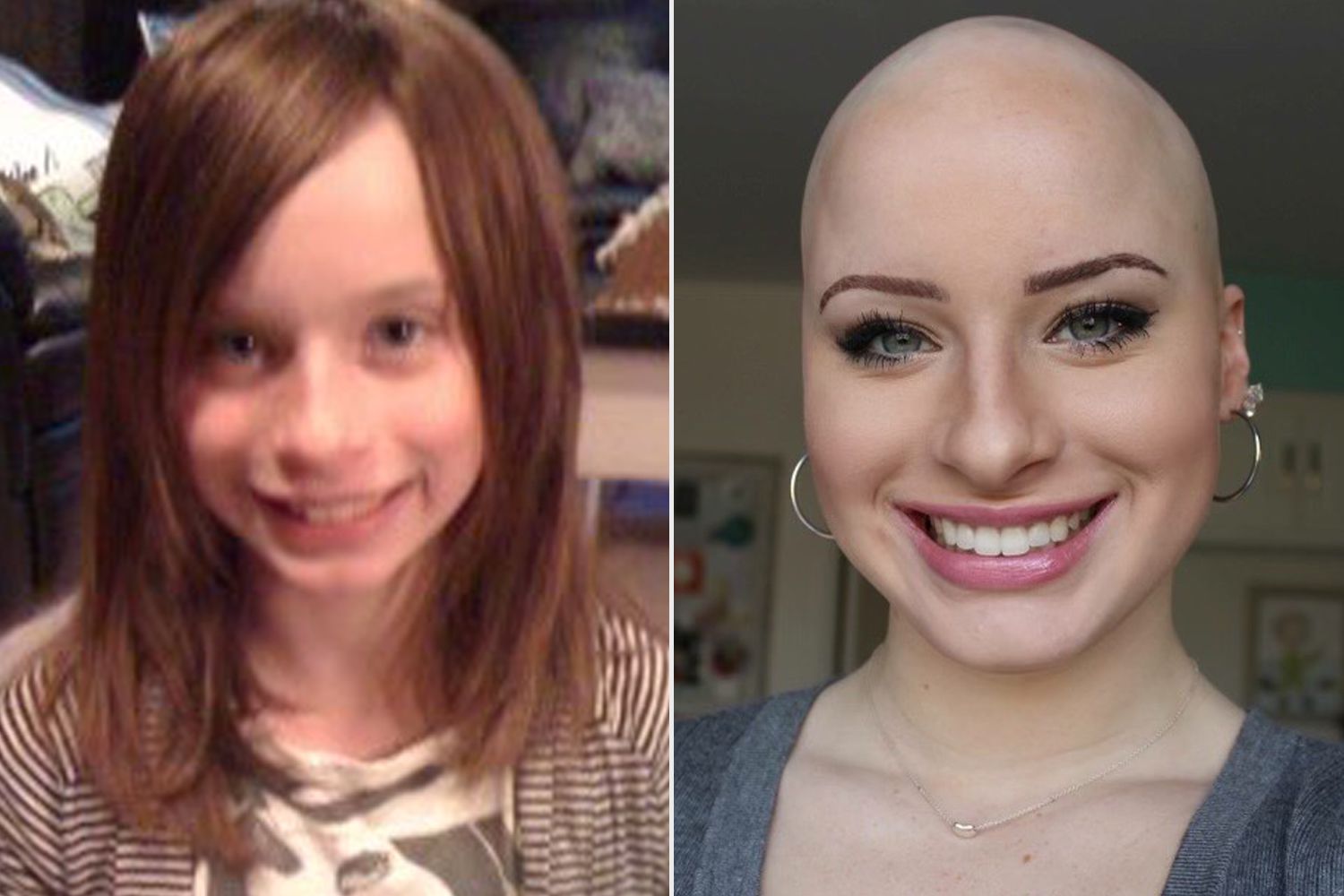 Chloe Bean Is a Bald Beauty Influencer with Alopecia (Exclusive) [Video]