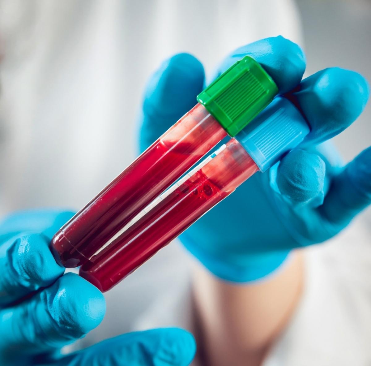 Blood-biomarker tests may aid in early diagnosis of Alzheimer’s: Report [Video]