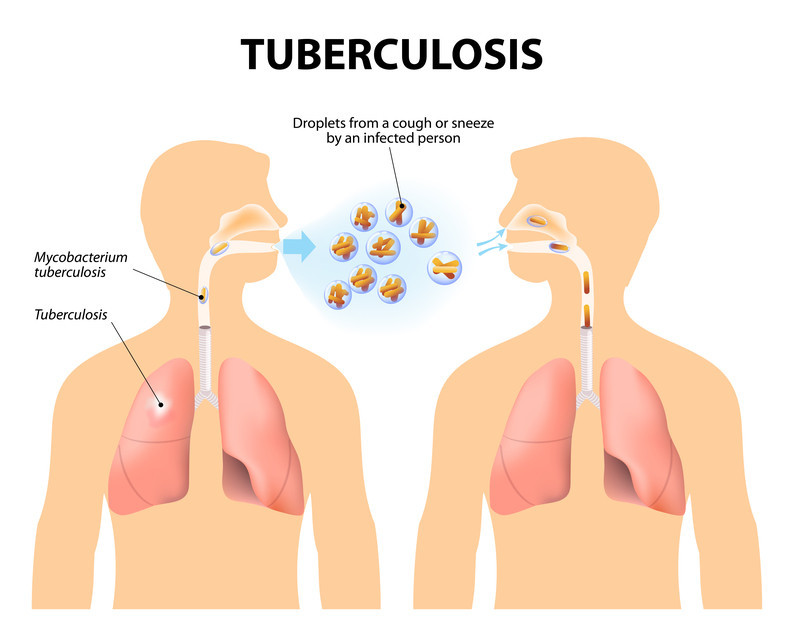 Self-Screening Speeds Up Tuberculosis Treatment, Says Health Minister [Video]