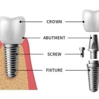 Pure Dental Health Elevates Full-Arch Dental Solutions with All-on-X, Zygomatic, and Pterygoid Implants | PR Newswire [Video]