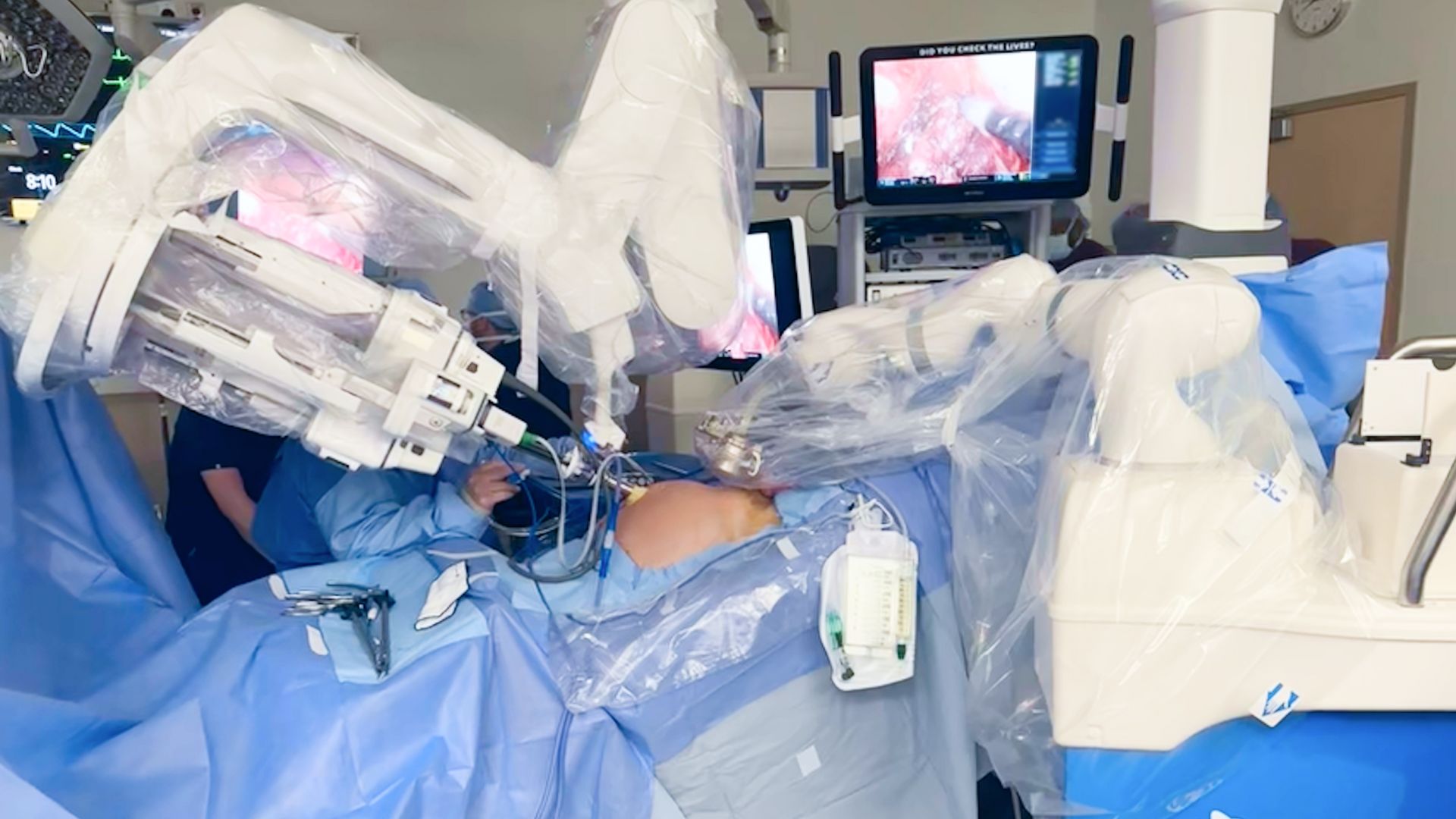 Groundbreaking dual-robot procedure advances minimally invasive surgery [Video]